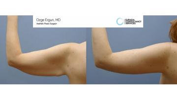 ArmLift_OE_1_2