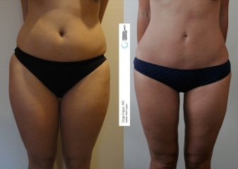 lipo11
