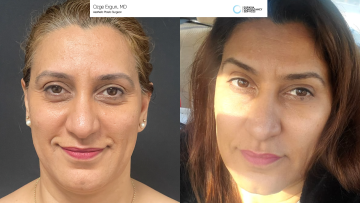 be_af_fatinjection_1_70849095