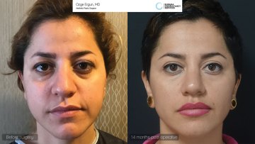 be_af_nvf_Redensity2_rhinoplasty1
