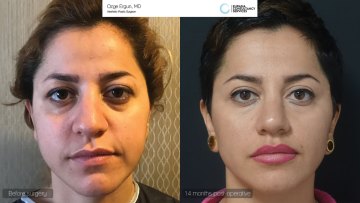 be_af_nvf_Redensity2_rhinoplasty1