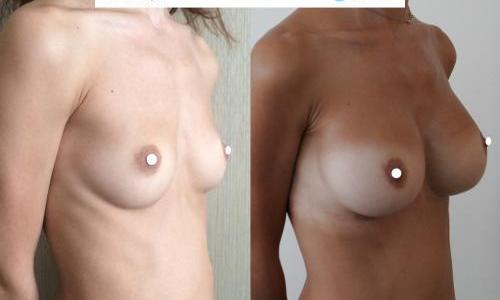 Breast Surgery