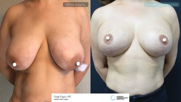 be_af_dtr_reduction_mammoplasty_1