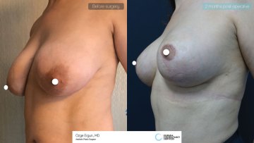 be_af_dtr_reduction_mammoplasty_2