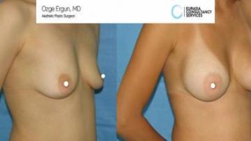 breast_implant_OE_1_2