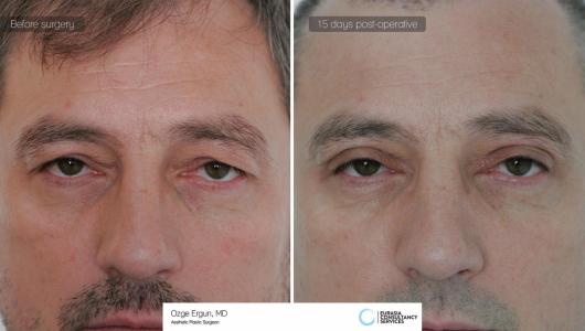 Eyelid Surgery