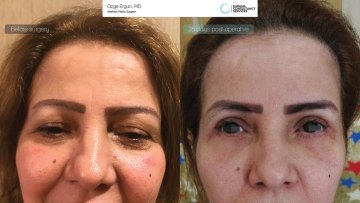 Eyelid_Dermal_Filler_before_after