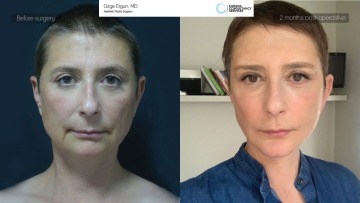 Ba_samantha_facelift