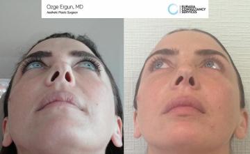 Face_Lift_OE_5_2_