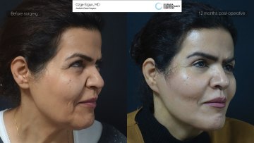 facelift before and after