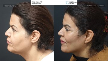 facelift before and after