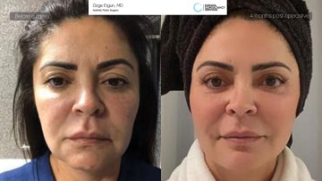 ba_lucenire_facelift