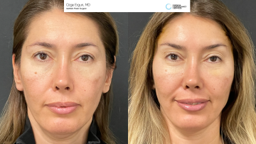 be_af_browlift_fatinj_69589575