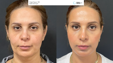 be_af_faceandnecklift_1_67212084