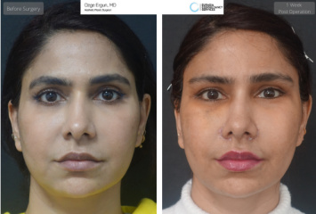 Copyete4r of Copy of before-and after