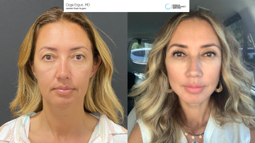 not-share-be_af_faceandnecklift_1_67528081