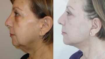 Face_Lift_OE_6_2