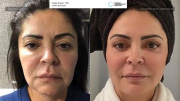 ba_lucenire_facelift