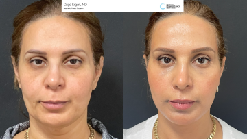 be_af_faceandnecklift_1_67212084