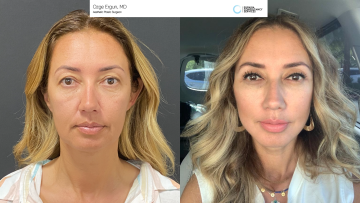 not-share-be_af_faceandnecklift_1_67528081