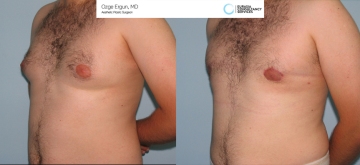 Gynecomastia_OE_1_1