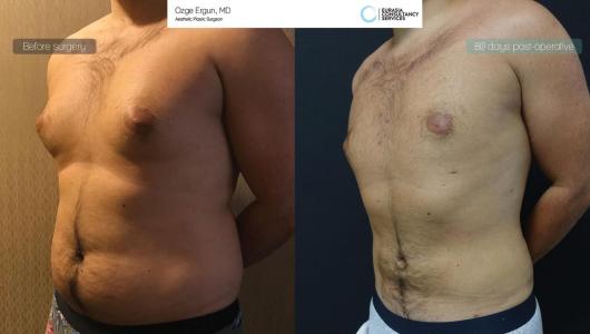 Gynecomastia