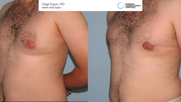 Gynecomastia_OE_1_1