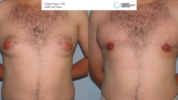 Gynecomastia_OE_1_2