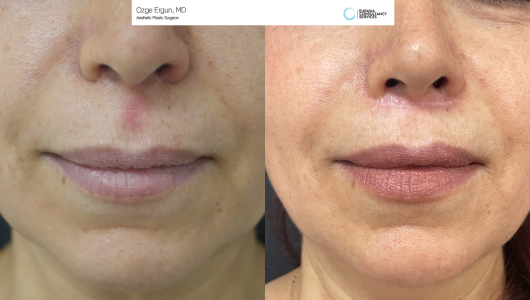 Lip  & Dimple Surgery