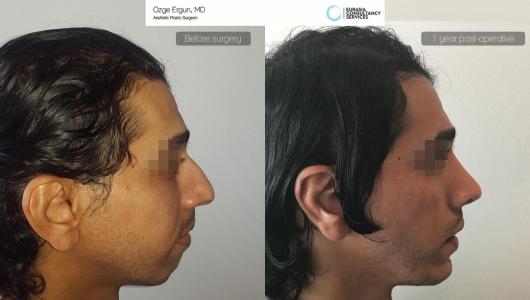 Rhinoplasty