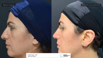 rhinoplasty