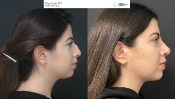 be-af-ADS-rhinoplasty-1