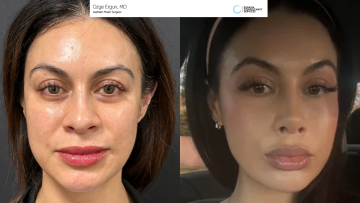 be_af_rhino_fatinj_liplift_1_70948801