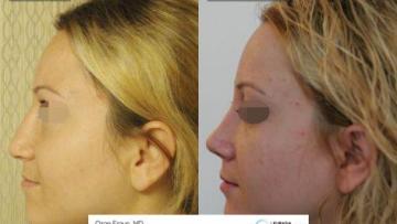 rhinoplasty