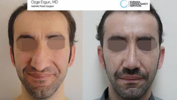 rhinoplasty