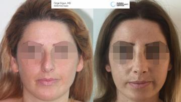 rhinoplasty