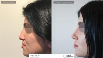 rhinoplasty