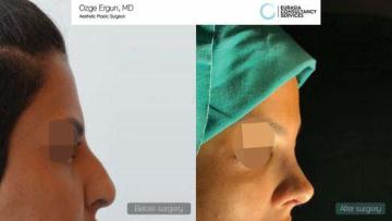 rhinoplasty