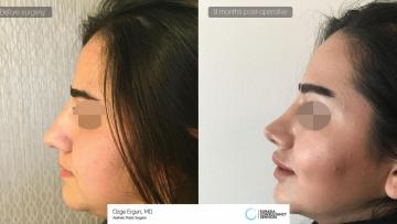 rhinoplasty