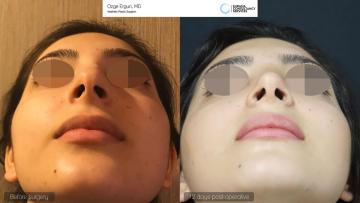 rhinoplasty