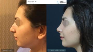 rhinoplasty