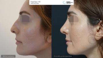 rhinoplasty