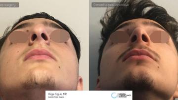 rhinoplasty