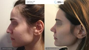 rhinoplasty