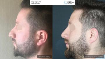 rhinoplasty