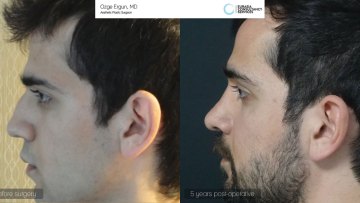 rhinoplasty