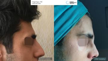 rhinoplasty