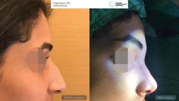 rhinoplasty