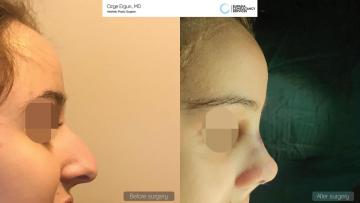 rhinoplasty