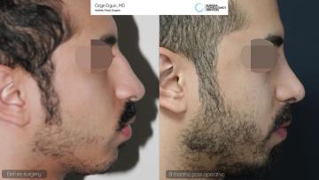 rhinoplasty